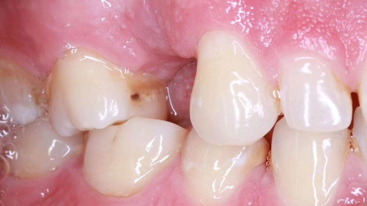 Dentes antes do implante, com o espaço de um dente perdido ao lado do canino