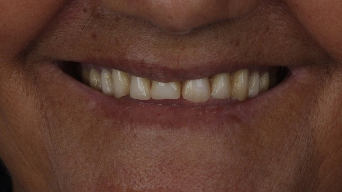 Sorriso antes da prótese protocolo, com dentes desgastados
