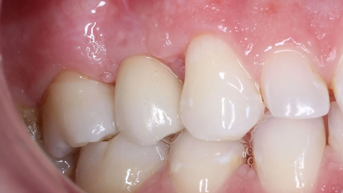 Dentes depois do implante, com a coroa no lugar do dente perdido