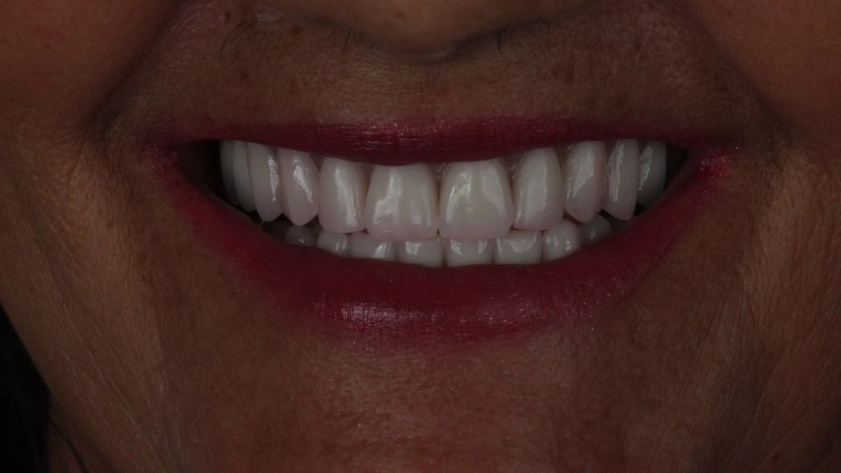 Sorriso depois da prótese protocolo