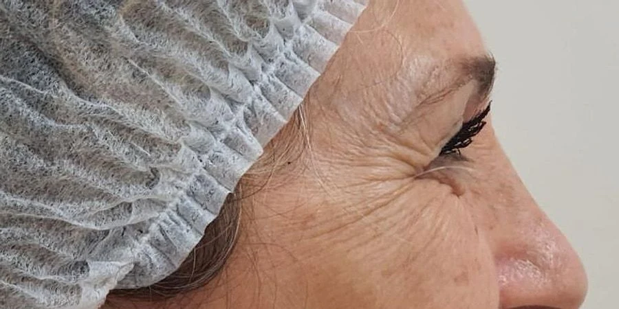 Rugas ao lado dos olhos, de perfil, antes do botox