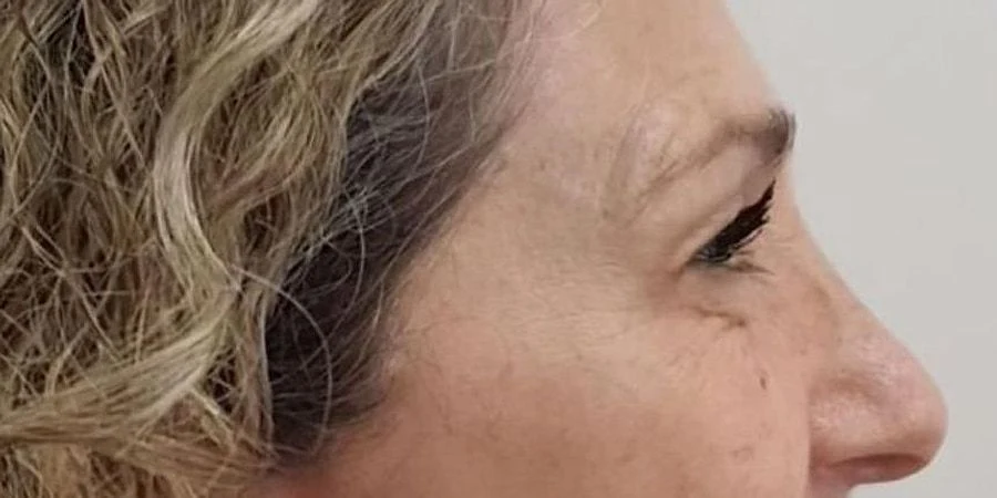 Região ao lado dos olhos, de perfil, depois do botox