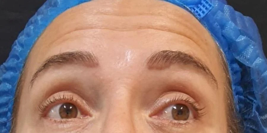 Testa com as linhas de expressão marcadas, antes do botox