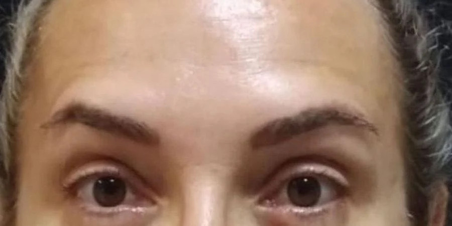 Testa depois do botox